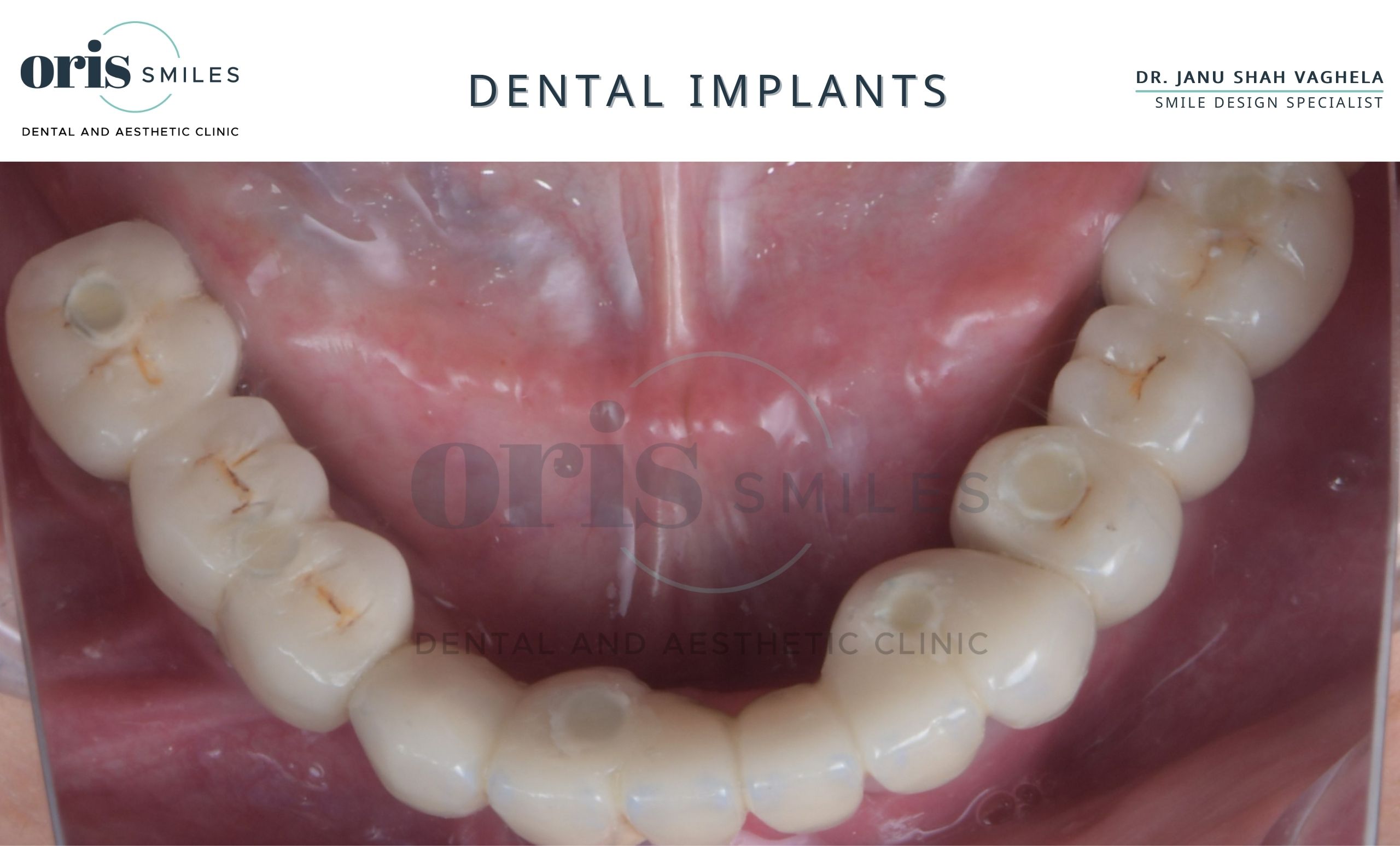 perfect dental implants in ahmedabad