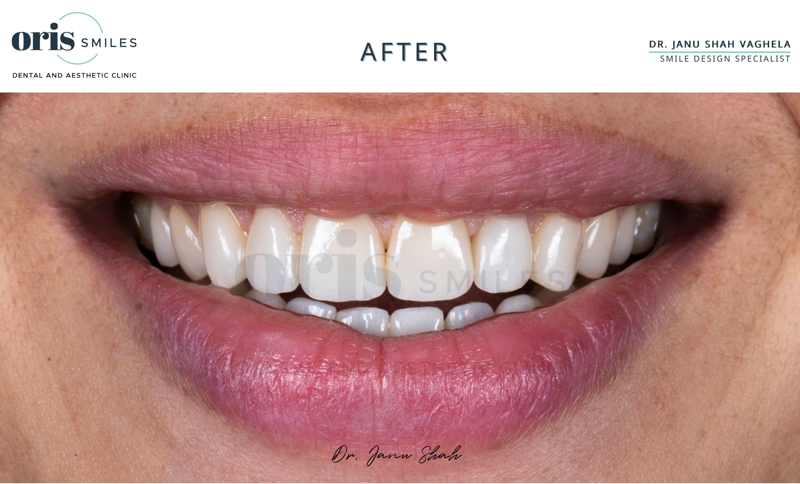 dental clinic in ahmedabad after of a case at oris smiles