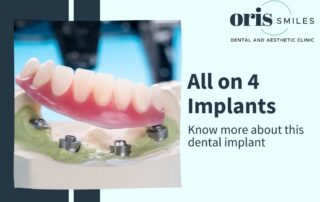 Know more about All on 4 Dental Implants