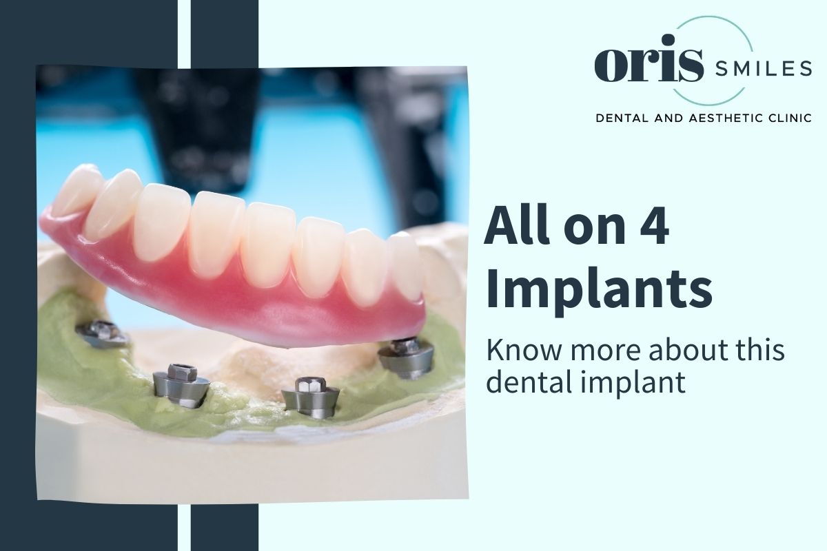 Know more about All on 4 Dental Implants