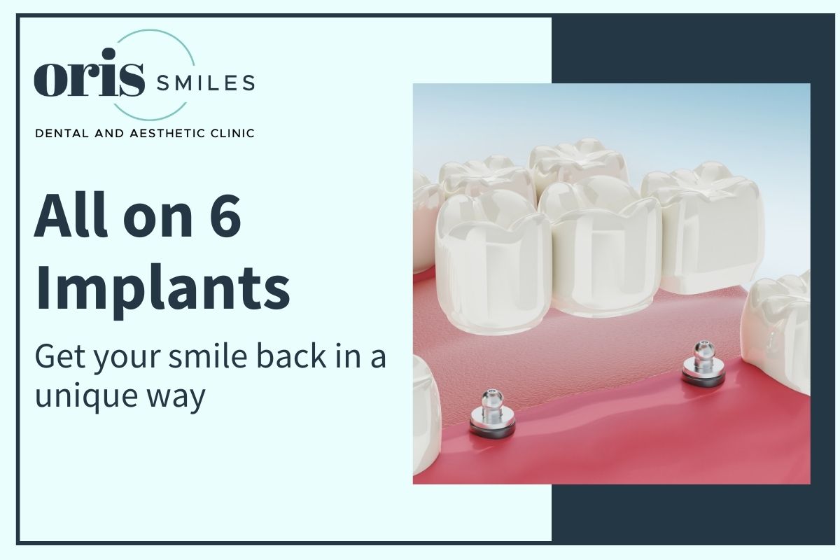 Restoring your smile and functionality with All on 6 Dental Implants