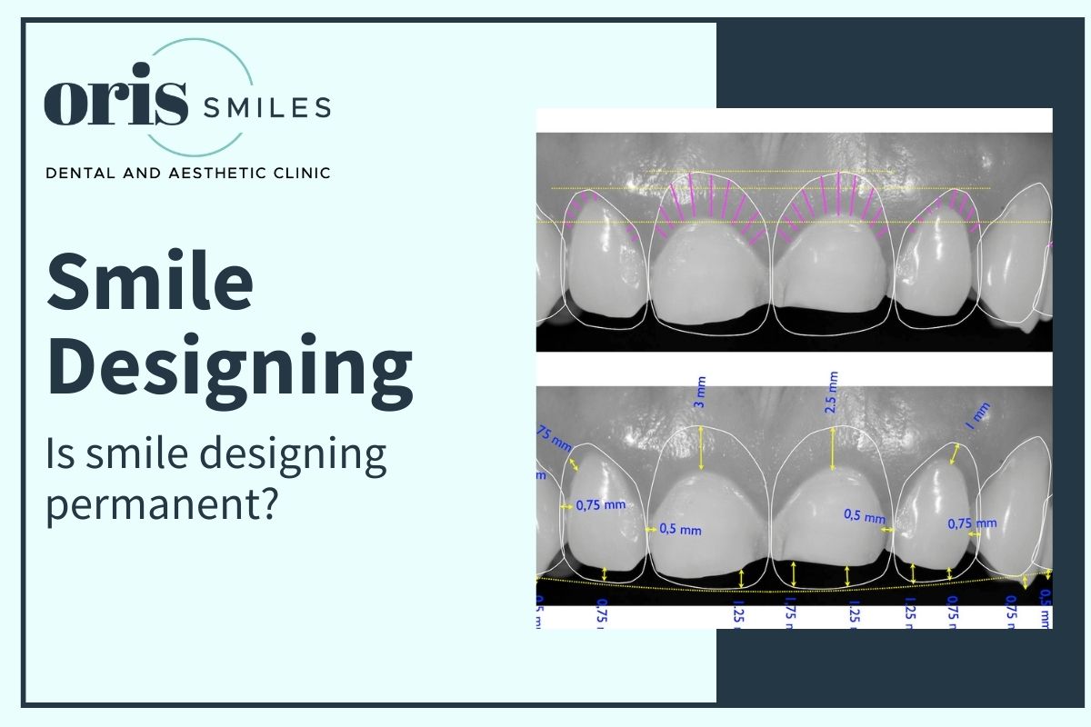 Is Smile Design Permanent