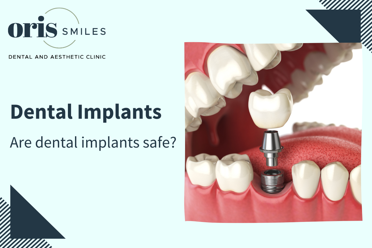 Are dental implants safe